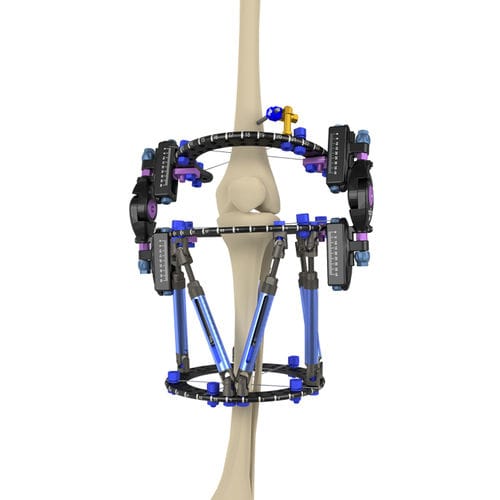 Hybrid Fixator