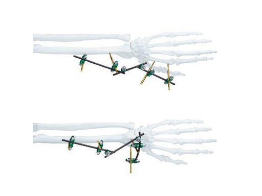 Small External Fixator